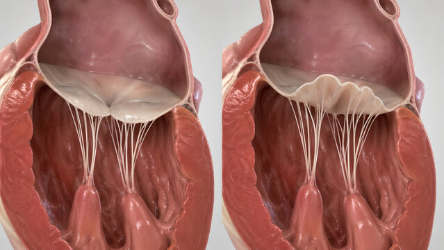 Mitral valve prolapse, leaflet billowing, left atrium, left ventricle, chordae tendineae, papillary muscles, heart cutaway, 3D anatomy, medical render