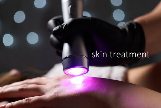A skin treatment is being performed on a hand using a blue light device in a clinical setting.