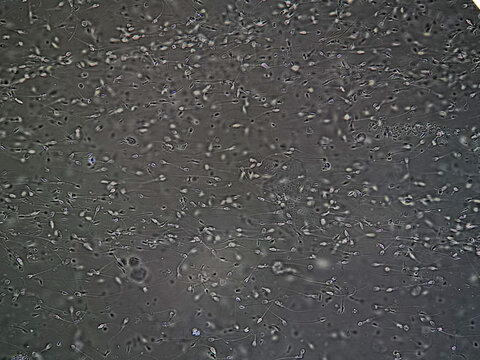 Sperm analysis on microscopic examination, Normozoospermia, normal semen analysis.