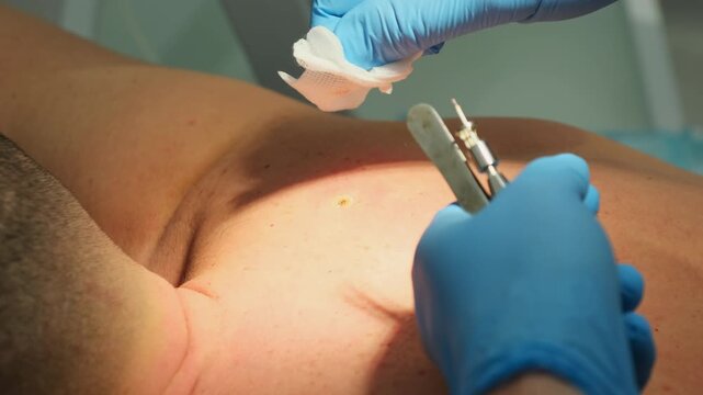 Surgeon hand wipes out blood from cut mole place on man shoulder in clinic slow motion. Doctor treats skin neoplasm on patient back in hospital