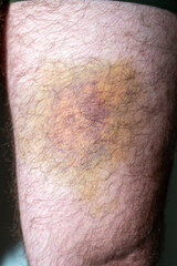 Naklejka premium Large hematoma bruise on human thigh