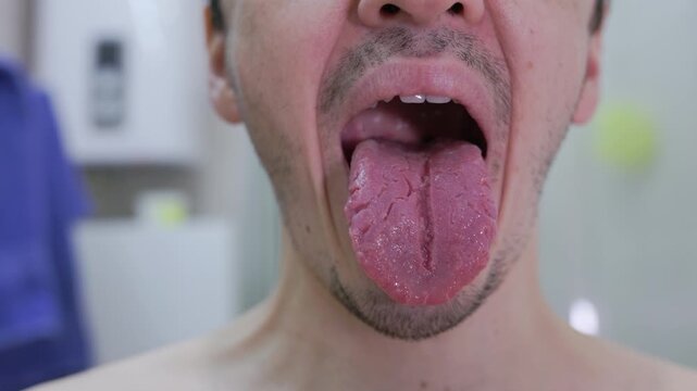 Close-up of man showing geographic tongue - fissured, map-like surface. Ideal for medical education, telehealth, dermatology & oral health content. Real patient, clinical setting