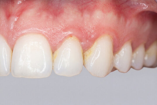 Macro of human teeth with dental plaque buildup and signs of gingivitis on the gums