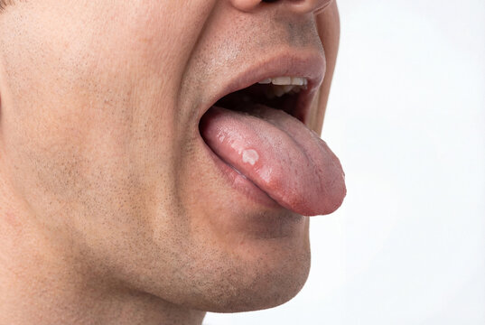 Man showing oral lesion on his tongue with open mouth close up
