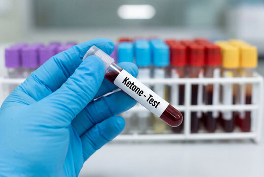 Gloved hand holding blood test tube labeled ketone in a laboratory