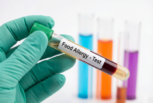 Doctor holding a blood sample for a food allergy test in a medical laboratory