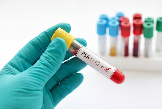 Positive PSA blood test result for prostate cancer screening held by a doctor