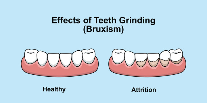 Effects of Teeth Grinding Bruxism Illustration Vector on Blue Background, Dental Concept Showing Tooth Wear, Jaw Clenching, Enamel Damage, and Oral Health Problems