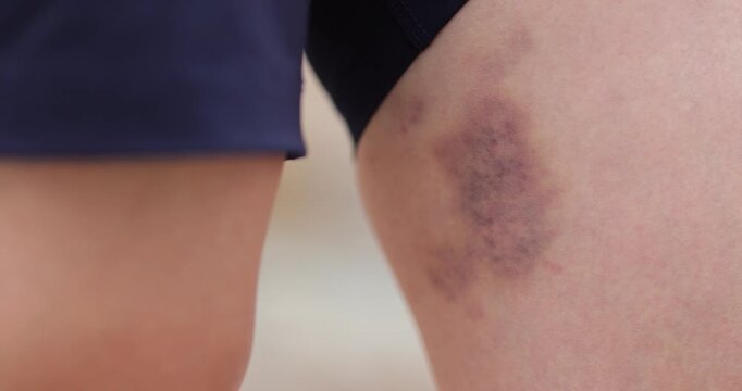 People show the bruised legs	