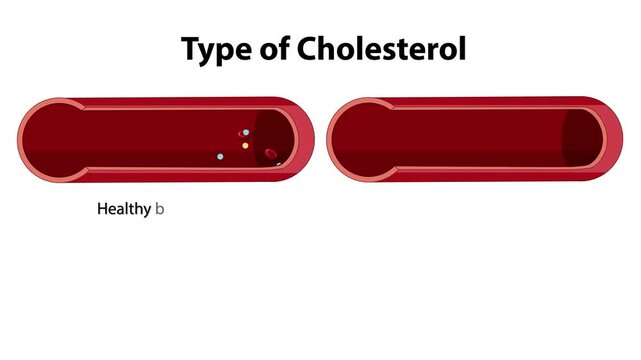 Comparison of healthy blood vessel with atherosclerosis showing cholesterol buildup in artery wall.