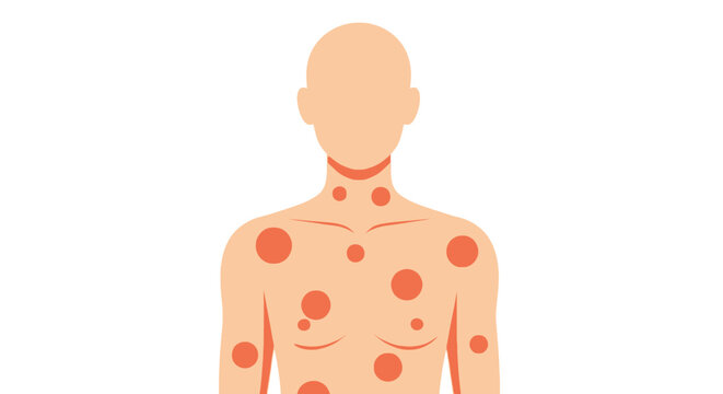 Illustration depicting a human torso and head covered in multiple circular red skin lesions or rashes
