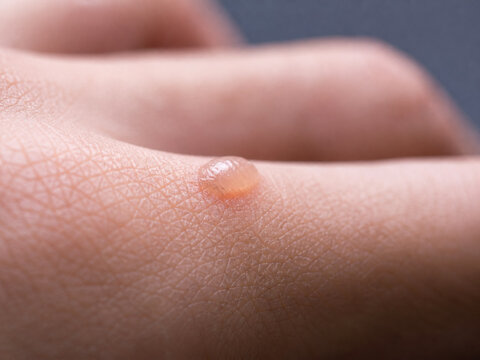 AI generated close up of human skin with small blister on hand surface showing texture detail dermatology condition irritation wound healthcare concept natural lighting soft focus background