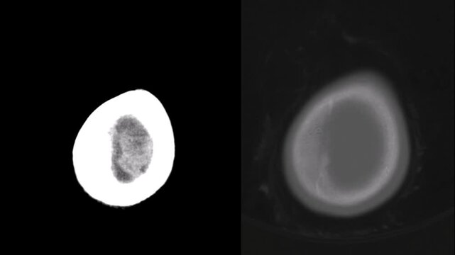 Pediatric hydrocephalus ventriculoperitoneal shunt brain scan. Medical 3D imaging showing surgical treatment progress for infant brain health management in diagnostic radiology clinic