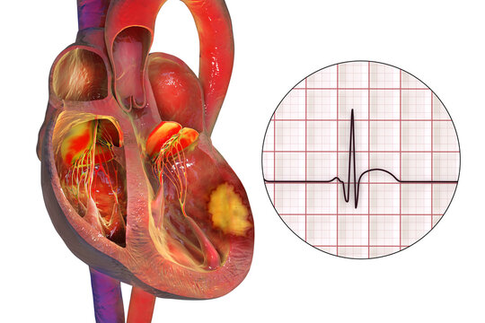 Transmural myocardial infarction with ventricular wall necrosis, combined with ECG showing pathological Q waves and ST-segment elevation, 3D illustration