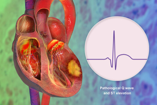 Transmural myocardial infarction with ventricular wall necrosis, combined with ECG showing pathological Q waves and ST-segment elevation, 3D illustration
