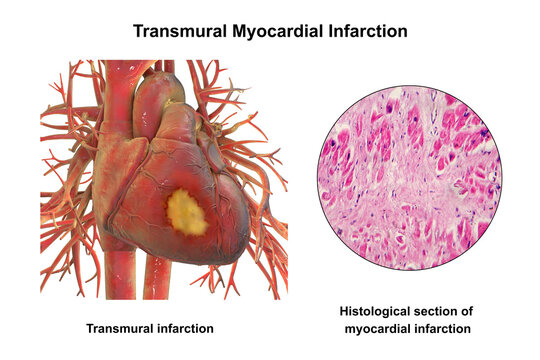 Transmural myocardial infarction with ventricular wall necrosis, 3D illustration, combined with micrograph showing cardiomyocyte necrosis, inflammatory infiltrates and fibrous scar tissue