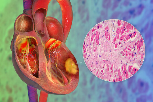 Transmural myocardial infarction with ventricular wall necrosis, 3D illustration, combined with micrograph showing cardiomyocyte necrosis, inflammatory infiltrates and fibrous scar tissue