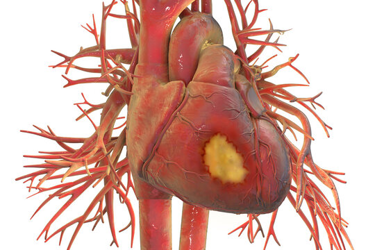 Human heart showing transmural myocardial infarction with extensive necrosis of the left ventricular wall, 3D illustration