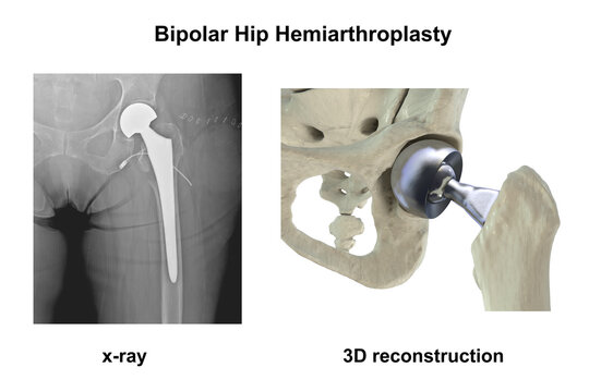 X-ray of bipolar hemiarthroplasty prosthesis in a female patient after femoral neck fracture, with 3D illustration showing dual mobility femoral head, stem and implant position in the hip joint