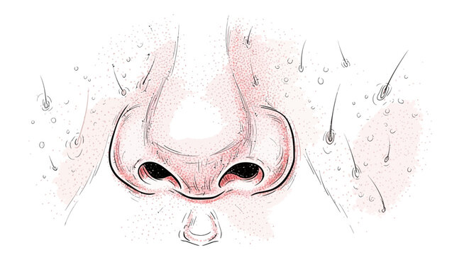 Illustration of a nose with red inflamed pores and blackheads