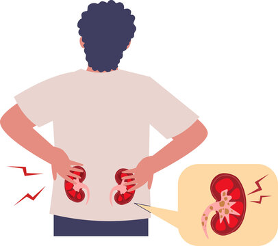 Man experiencing back pain, illustration of kidney stones and backache