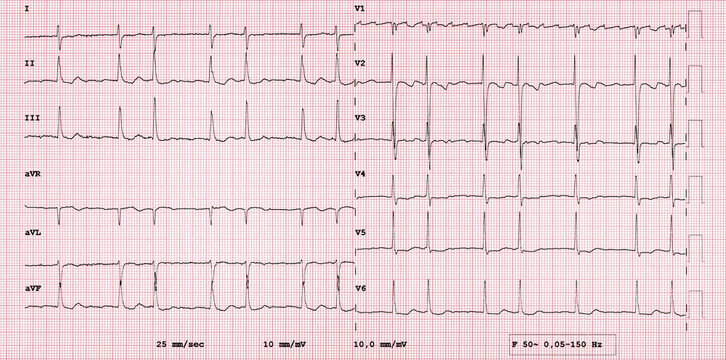 Electrocardiogram Showing Atrial Flutter and Atrial Fibrillation on ECG Trace