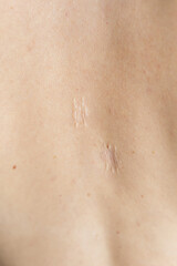 Naklejka premium Scars on the skin due to wound dehiscence, mole removal