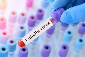 Obraz premium Doctor holding blood sample tube with rubella test in clinical laboratory, serological blood analysis for viral infection immunity screening, prenatal diagnostics and preventive healthcare concept