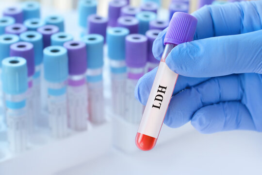 Doctor holding blood sample tube with LDH test in modern medical laboratory, biochemical blood analysis for diagnostics of tissue damage, cell breakdown and metabolic disorders in healthcare