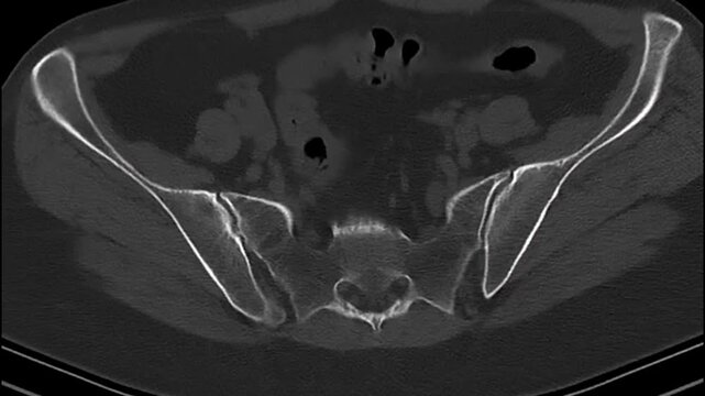 Computed Tomography scan axial view human pelvis. Medical imaging showing sacrum and sacroiliac joints for orthopedic diagnostic and educational healthcare use