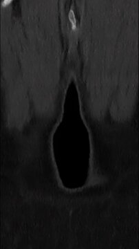 Coronal Computed Tomography scan lumbar spine spondylolisthesis Medical imaging showing vertebral column alignment and isthmic defect for orthopedic diagnosis and spinal surgery educational healthcare