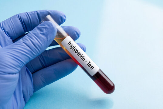 Doctor gloved hand holding a test tube labeled triglyceride test for diagnosis
