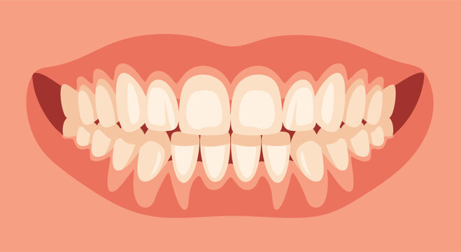 Dental malocclusion illustration showing misaligned upper and lower teeth with pink gums and coral tones. Perfect for orthodontic treatment concepts, dental health education, bite correction diagrams
