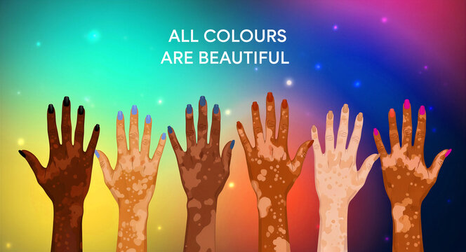 Diverse hands with vitiligo raised against a colorful background with inclusive text. Various skin tones show unique pigmentation patterns. Ideal for diversity, inclusion, and equality campaigns.