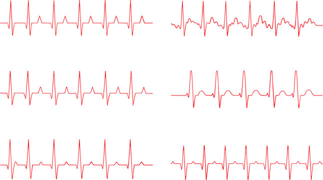 Red Electrocardiogram (ECG) Waveforms Showing Normal and Abnormal Heart Rhythm Signals for Medical, Diagnostic, and Educational Illustration