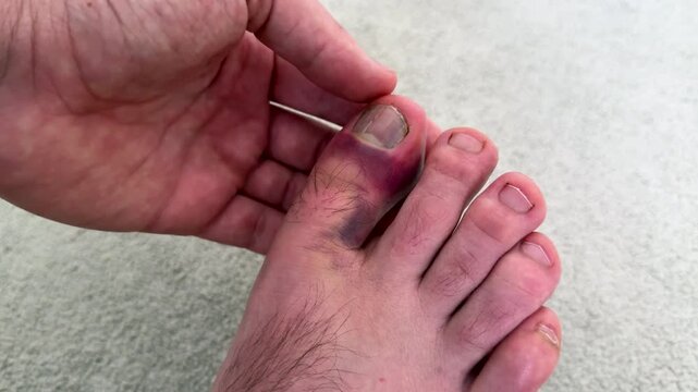 Male foot with visible hematoma on the toe as hand gently examines the injury, showcasing the progression of swelling and discoloration in a close-up view