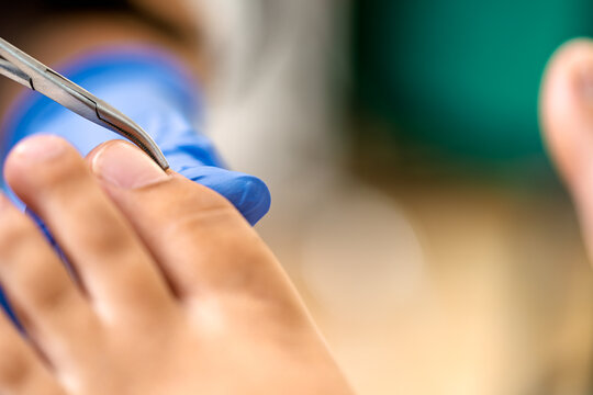 Podiatrist treating client's foot, removing ingrown toenail