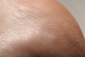 Naklejka premium Man with dry skin on his heel against light background, closeup