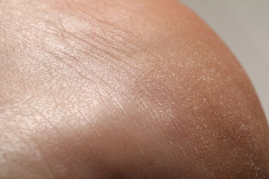 Man with dry skin on his heel against light background, closeup