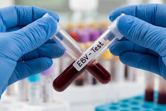 Gloved hands holding two blood test tubes labeled EBV in laboratory