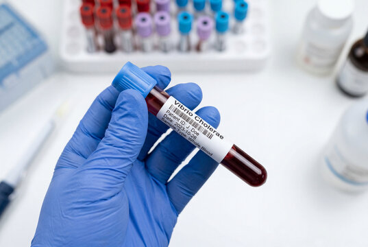 Gloved hand holding a blood sample tube labeled vibrio cholerae
