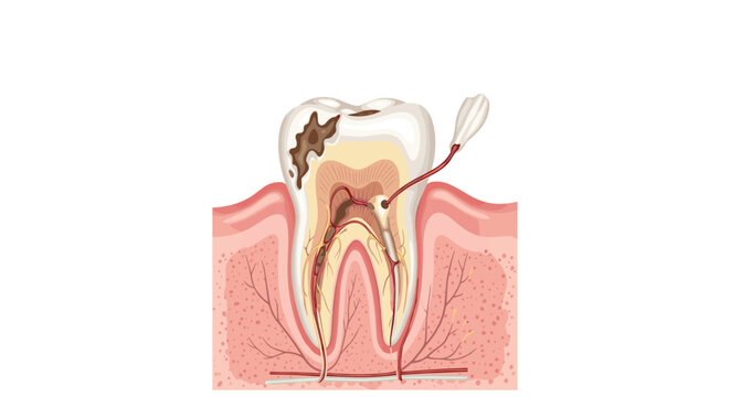 Medical diagram of a human tooth showing deep dental decay reaching the pulp and the steps of a professional root canal treatment procedure.