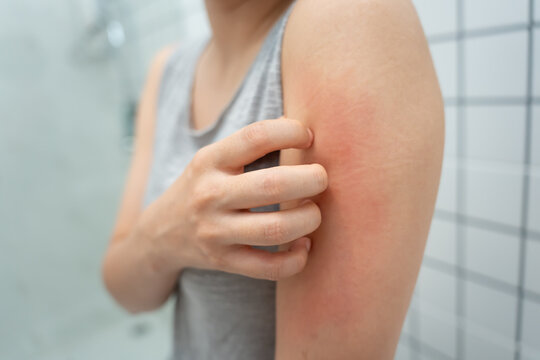 skin problem and beauty. woman scratch body has itchy skin from skin allergic, steroid allergy, sensitive skin, red from sunburn, chemical allergy, rash, insect bites, Seborrheic Dermatitis.