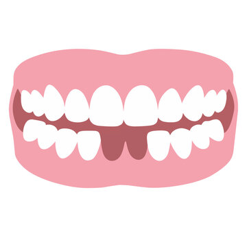 Illustration of Dentures with Missing Teeth