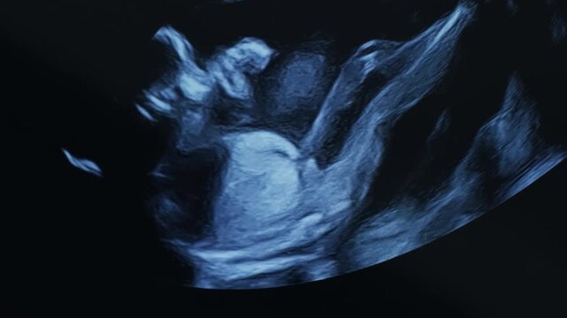 Ultrasound video showing a developing baby in the womb. Detailed prenatal imaging captures gentle movements, heartbeat, and early development stages. Authentic medical footage suitable for healthcare