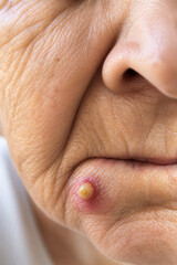Naklejka premium Macro close-up of mature Caucasian woman with light skin, wrinkles and inflamed chin pustule, natural texture, soft light, dermatology skincare and aging skin concept.