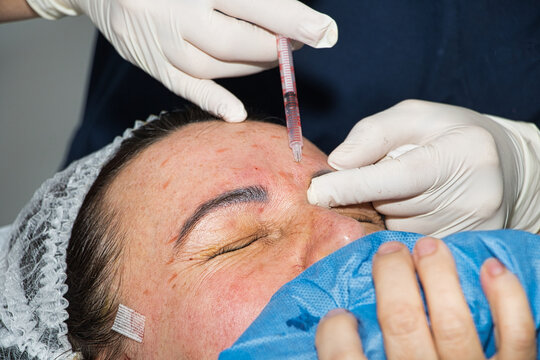 Facial rejuvenation with injections, close-up of injection from a syringe..