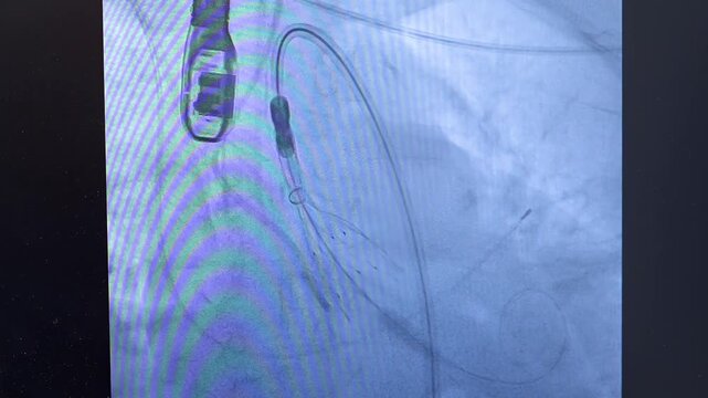 Cardiology clinic. Operating room in the cardiology department. Aortocoronary bypass surgery. This is what coronary artery bypass grafting looks like on a monitor.