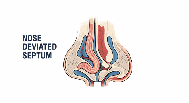 Anatomical cross-section of a deviated nasal septum with labels