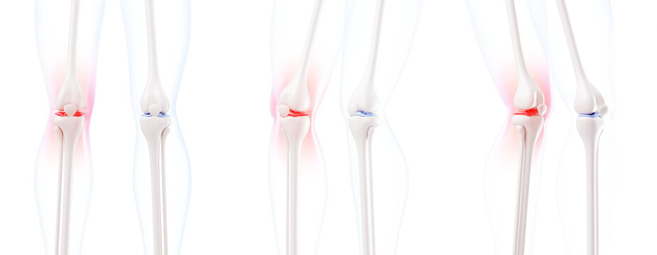 3d knee pain and healthy joint anatomy - leg bones with red glowing inflammation in different angles on blue bg. Medical concept, meniscus tear, repair damaged cartilage and ligaments